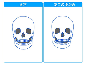 顎へのダメージ