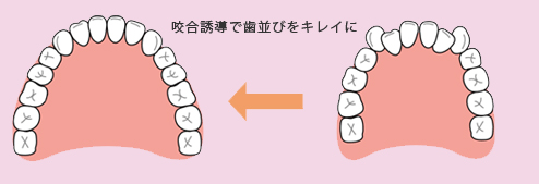 咬合誘導で歯並びをキレイに